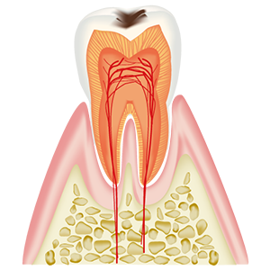 C1エナメル虫歯