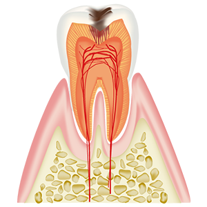 象牙質虫歯