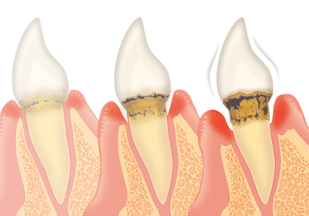 歯周病の歯の状態